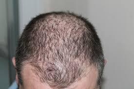 Hair Loss Reversed Thanks To This