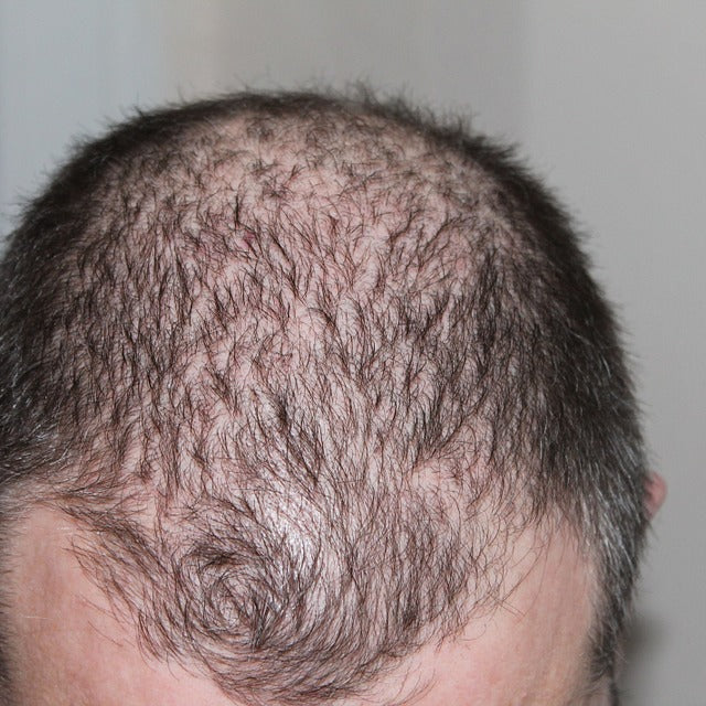 A Proven Treatment For Hair Loss