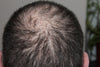 Hair Loss Reversal in a Protein?