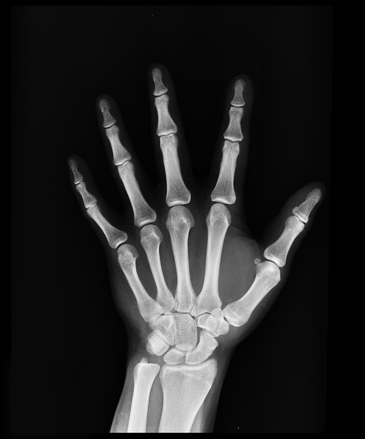 New Drug Makes Bones Stronger but Doesn’t Keep Them Safer