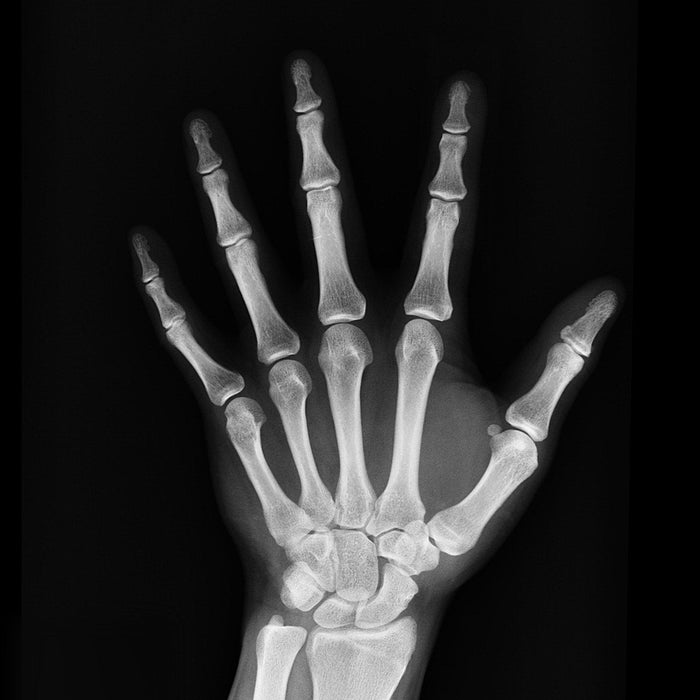New Drug Makes Bones Stronger but Doesn’t Keep Them Safer